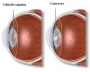 100 lei reducere la operatia de cataracta 